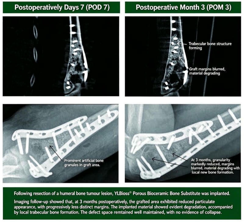 Humeral bone tumour lesion clinical imaging